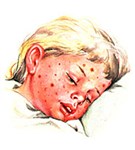 Ветряная оспа