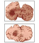 Очаг кровоизлияния в полушарии
