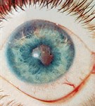 Передний Увеит