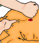 Прекардиальный удар