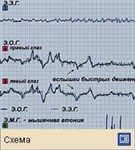 Сон (Э.Э.Г.-Э.О.Г.-Э.М.Г.-регистрация во время парадоксального сна)