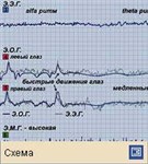Сон (Э.Э.Г.-Э.О.Г.-Э.М.Г.-регистрация во время стадии 1)