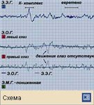Сон (Э.Э.Г.-Э.О.Г.-Э.М.Г.-регистрация во время стадии 2)
