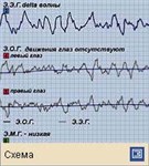 Сон (Э.Э.Г.-Э.О.Г.-Э.М.Г.-регистрация во время стадий 3 и 4)