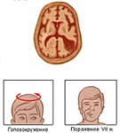Сотрясение и Ушиб головного мозга (клинические симптомы)