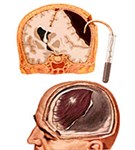 Удаление внутричерепной гематомы