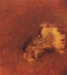 Хориоретинит (исход)