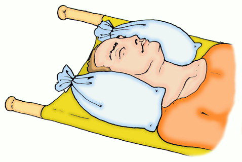 транспортировка при черепно-мозговой травме. перелом основания черепа первая помощь. при переломе костей черепа больного транспортируют:. при переломе черепа пострадавшему. транспортировка пострадавших с повреждением спинного мозга.