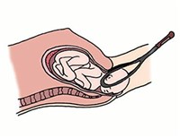 АКУШЕРСКИЕ ЩИПЦЫ