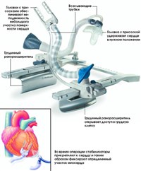 АППАРАТ ИСКУССТВЕННОГО КРОВООБРАЩЕНИЯ (схема)