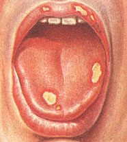 АФТОЗНЫЙ СТОМАТИТ