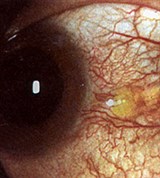 Абсцесс склеры