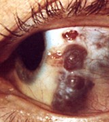 Абсцесс склеры (исход в истончение и растяжение)