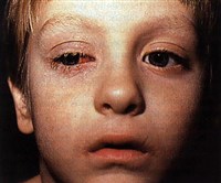 Аденовирусная инфекция