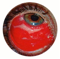 Аденовирусный Конъюнктивит