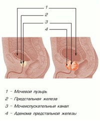 Аденома предстательной железы