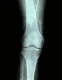 Ангиография