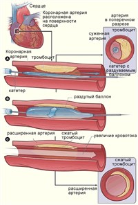 Ангиопластика (схема)