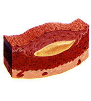 Атеросклеротическая бляшка