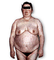 Болезнь Иценко-Кушинга