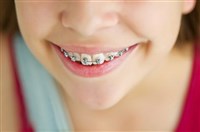 Брекеты ребенку