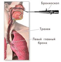 Бронхоскопия (схема)