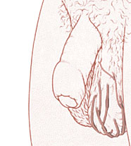 ВАРИКОЦЕЛЕ