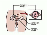 ВНЕМАТОЧНАЯ БЕРЕМЕННОСТЬ (схема)