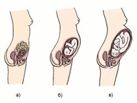 ВНУТРИУТРОБНЫЙ ПЛОД