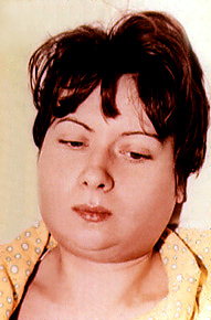 ВОСПАЛЕНИЕ ЛЕВОЙ ОКОЛОУШНОЙ ЖЕЛЕЗЫ