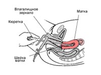 ВЫСКАБЛИВАНИЕ МАТКИ (схема)