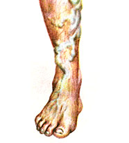 Варикозное расширение вен