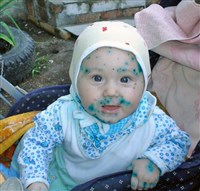 Ветряная оспа (у ребенка)