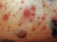 Ветряночная сыпь