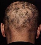 Вторичный Сифилис: сифилитическая Алопеция