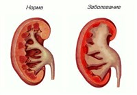 ГИДРОНЕФРОЗ