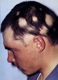 ГНЕЗДНАЯ АЛОПЕЦИЯ