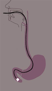 Гастроскопия (схема)