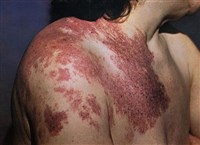 Гемангиома