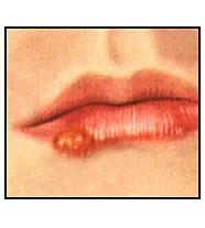 Герпетическая инфекция