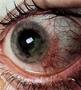 Герпетический Язвенный кератоиридоциклит
