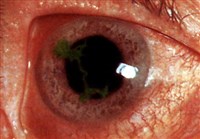 Герпетический древовидный кератит