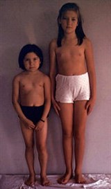 Гипотиреоз