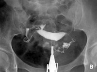 Гистеросальпингография