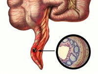 Гнойный Аппендицит