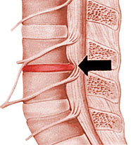 Грыжа межпозвонкового диска