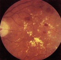 ДИАБЕТИЧЕСКАЯ РЕТИНОПАТИЯ