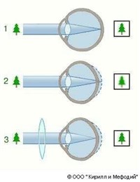Дальнозоркость (схема)