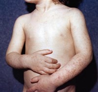 Детская Почесуха