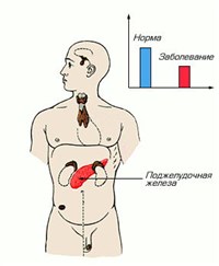 Диабет сахарный